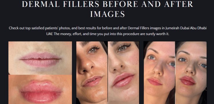 Smile Line Fillers in Dubai: Erase Wrinkles Around Your Mouth